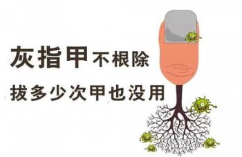 杭州治疗灰指甲要多少钱